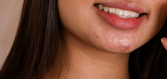 Does Touching Your Face Cause Acne? Here's What You Need to Know
