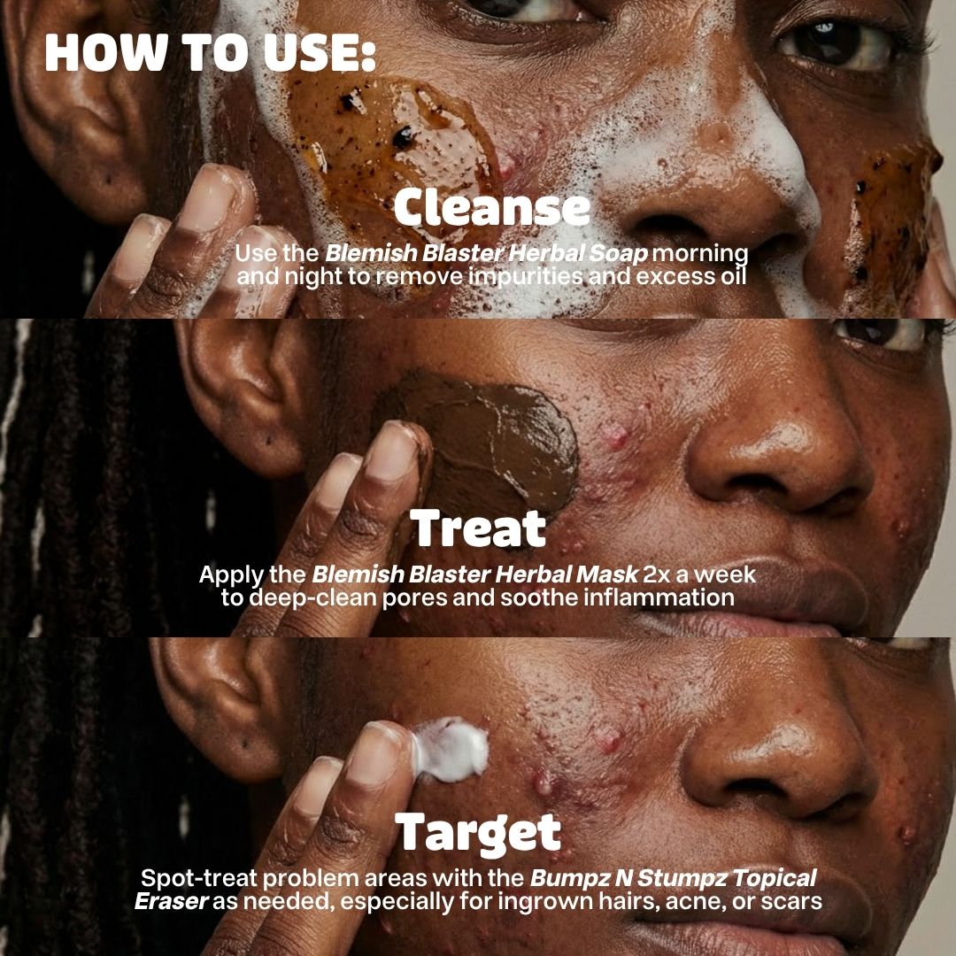 The Acne Buster Package