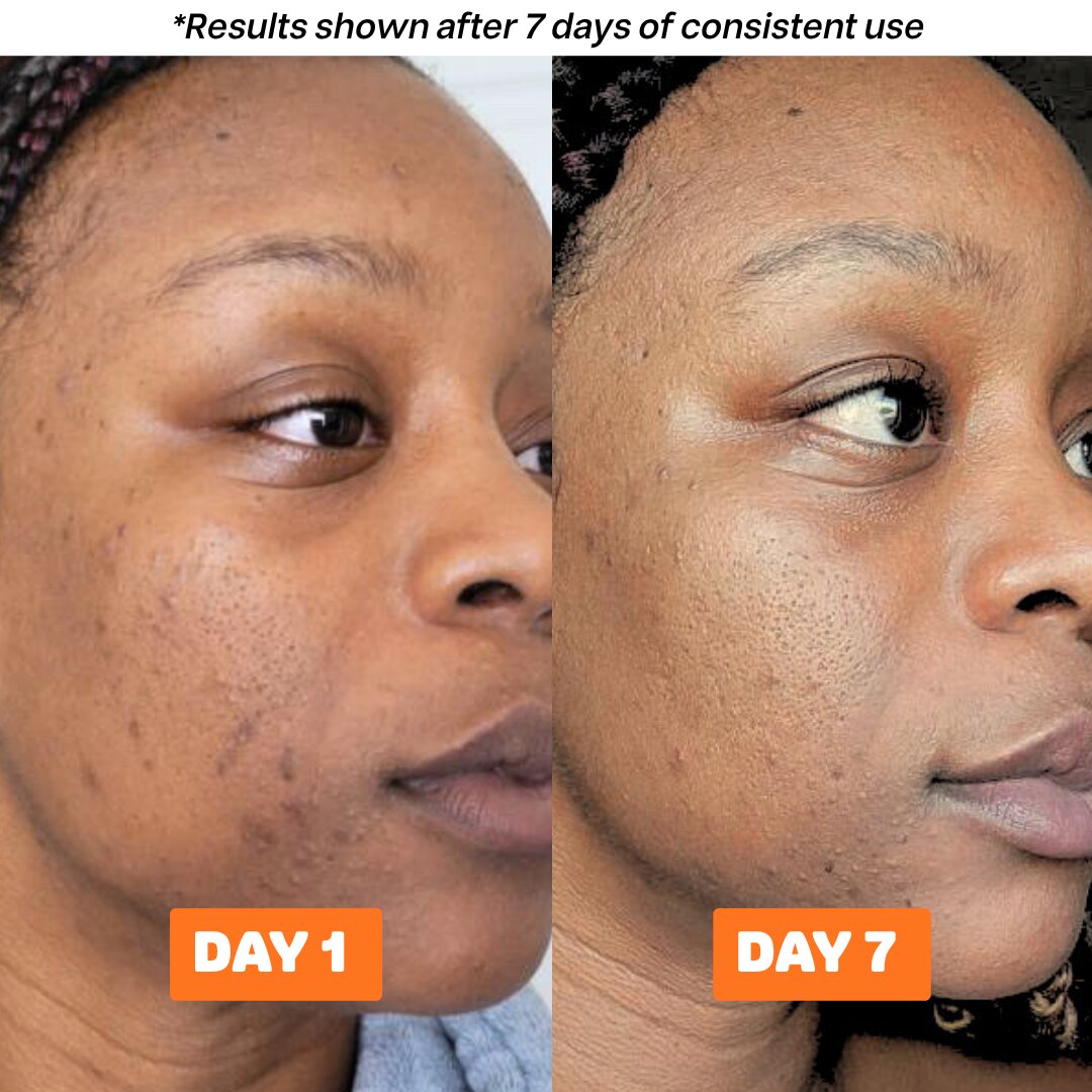 The Acne Buster Package